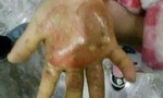 Trung Quốc: Bé gái bị mẹ nhúng tay vào nước sôi, sau đó xát muối vào vết phỏng