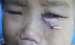 Té võng, bé trai 4 tuổi bị kim đâm thủng hốc mắt