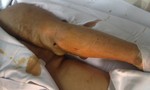 Người phụ nữ đau đớn ôm cánh tay biến dạng đến bệnh viện do trúng mảnh hỏa khí