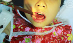 Bé gái bị đôi đũa xuyên thủng lưỡi trong lúc ăn cơm