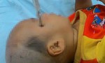 Bé trai 14 tháng tuổi bị tuốc vít đâm vào đầu
