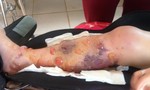 Đắk Lắk: Bác sĩ tắc trách, nữ sinh lớp 10 phải cưa một chân