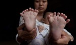 Bé trai sinh ra có 31 ngón tay và ngón chân