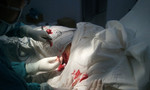 Mổ cấp cứu xuyên đêm cứu bệnh nhân bị đâm thủng ngực