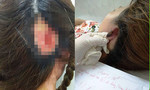 Làm đẹp đón Tết: 2 phụ nữ nhập viện vì hoại tử vành tai, mất da đầu