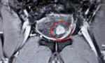 Cắt ruột non tạo bàng quang cứu người đàn ông mang khối u ác tính