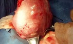 Phẫu thuật cắt bỏ khối u xơ nặng gần 4kg trong người bệnh nhân