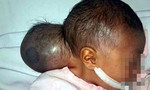Bé gái 2 ngày tuổi mang 'hai đầu' bị mẹ bỏ rơi tại bệnh viện