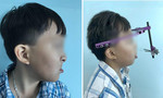 Kéo giãn xương hàm 20cm tái tạo khuôn mặt cho bé trai 10 tuổi