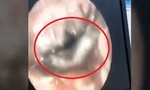 Con sâu làm tổ trong lỗ tai bé gái 4 tháng tuổi