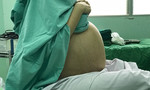 Cô gái mang khối u khổng lồ khiến bụng to như mang bầu 9 tháng