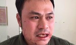 Nhân viên an ninh sân bay Nội Bài bị hành hung, đánh gãy răng