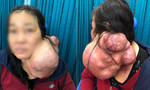 Cắt khối u khổng lồ đeo trên cổ người phụ nữ 25 năm