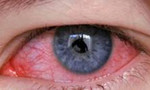 Mùa nắng nóng, cẩn trọng các bệnh về mắt