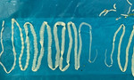 Hai con sán dây dài 2m ký sinh trong người đàn ông
