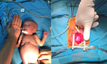 Phẫu thuật tim cho bé gái song sinh có trái tim nhỏ như ngón tay cái