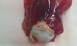 Cắt khối u trong tim to như trứng vịt khỏi người nữ bệnh nhân