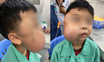 ​Cắt khối u vòm mũi họng khổng lồ cho bé trai 13 tuổi