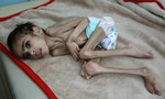 Xót xa cậu bé Yemen 7 tuổi nặng chỉ 7kg vì nạn đói