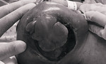 Bé sơ sinh mang khối u quái khổng lồ vùng cùng cụt