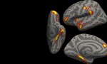 Nhiễm Covid-19 triệu chứng nhẹ cũng có thể khiến não lão hoá
