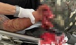 Một thanh niên bị pháo nổ dập nát cụt bàn tay
