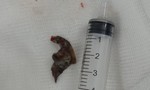 Gắp chiếc xương cá nằm trong phổi bệnh nhân 4 tuần