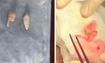 Cứu sống nam sinh bị răng người khác cắm sâu vào não