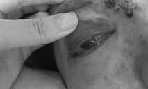Một phụ nữ bị mù mắt vì tiêm filler làm đẹp