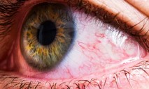 Viêm kết mạc xuất huyết là biểu hiện chủ yếu gây ra đau mắt đỏ tại TPHCM