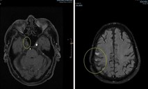 Ca nhồi máu não cấp thứ 4 được cứu sống tại Trung tâm Y tế Quân dân y đặc khu Côn Đảo