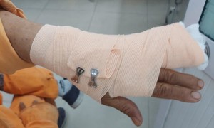 Điều tra vụ nhân viên điện lực bị đánh đứt gân ngón tay khi đi nhắc nợ
