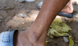 Tây Ninh: Nhiều người dân bị côn trùng “lạ” cắn gây mẩn ngứa khắp cơ thể