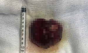 Lấy khối u “khổng lồ” ra khỏi người nam bệnh nhân