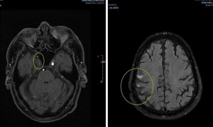 Ca nhồi máu não cấp thứ 4 được cứu sống tại Trung tâm Y tế Quân dân y đặc khu Côn Đảo