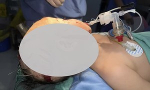 Bé trai 26 tháng tuổi bị chó nhà ông ngoại cắn nát vùng hàm mặt