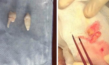 Cứu sống nam sinh bị răng người khác cắm sâu vào não