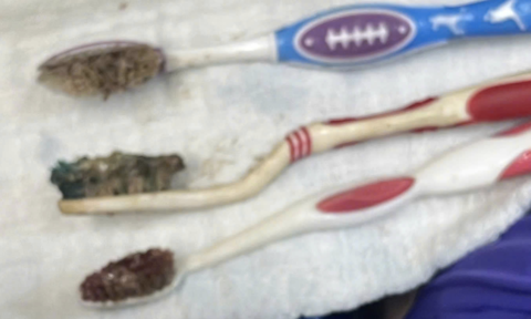 Nội soi gắp 3 chiếc bàn chải đánh răng dài gần 20cm trong bụng bệnh nhân