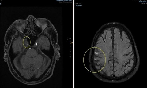 Ca nhồi máu não cấp thứ 4 được cứu sống tại Trung tâm Y tế Quân dân y đặc khu Côn Đảo
